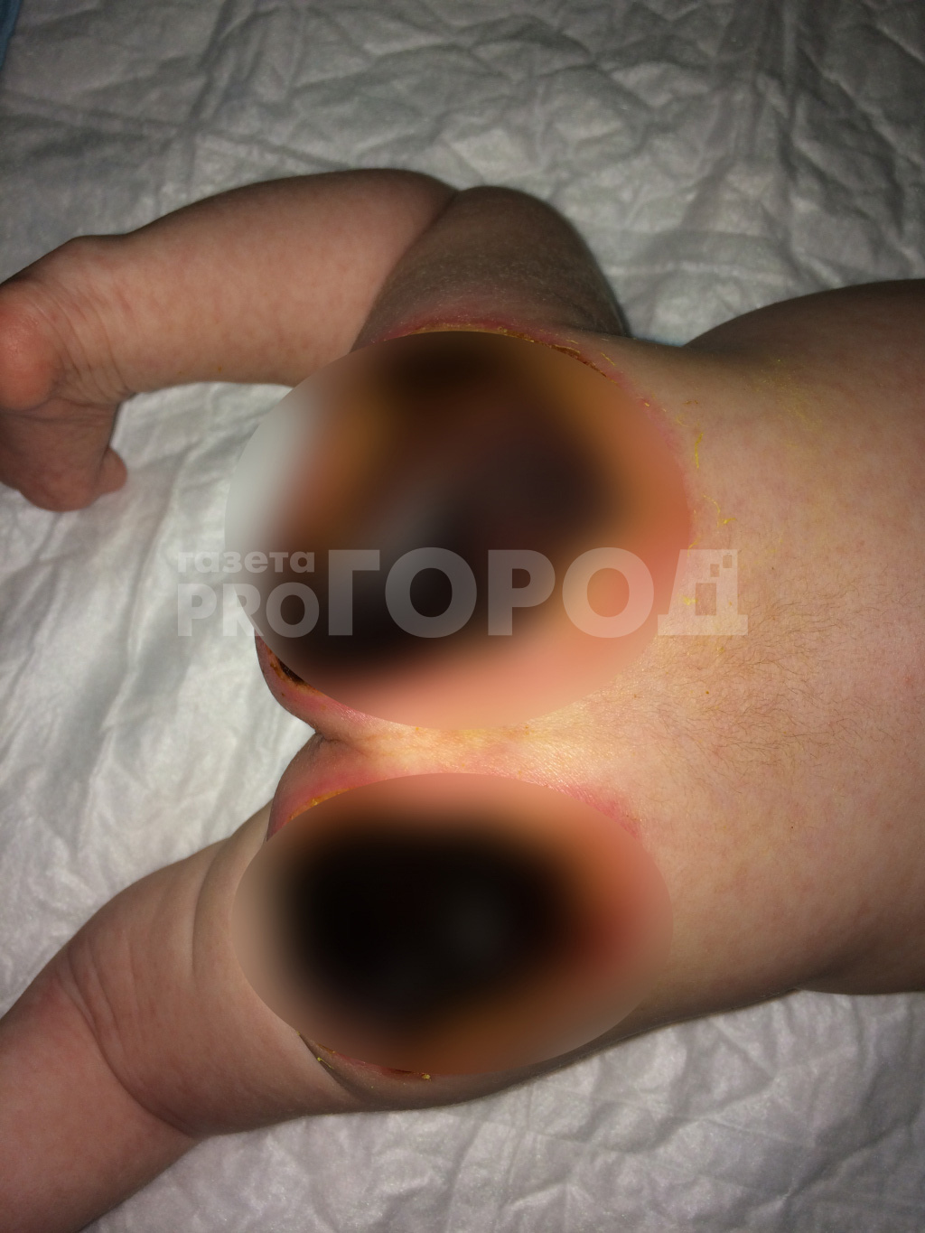 Ожог ребенка в Нижегородской больнице