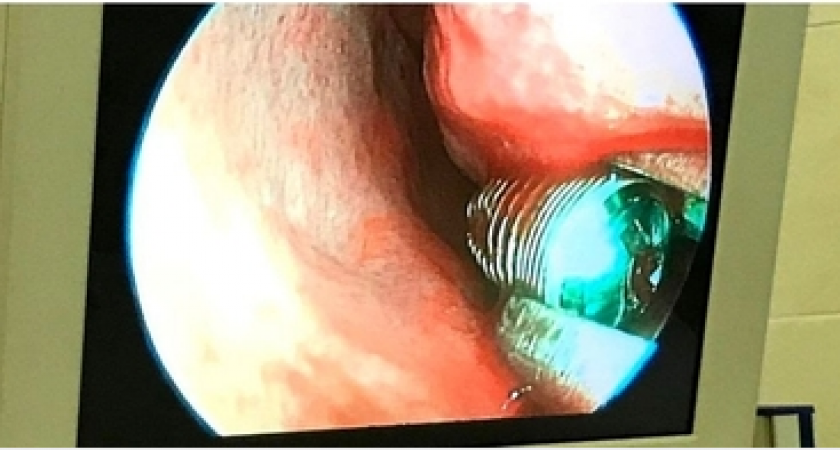 Медики спасли жизнь пациенту, у которого в носу застрял зубной имплант