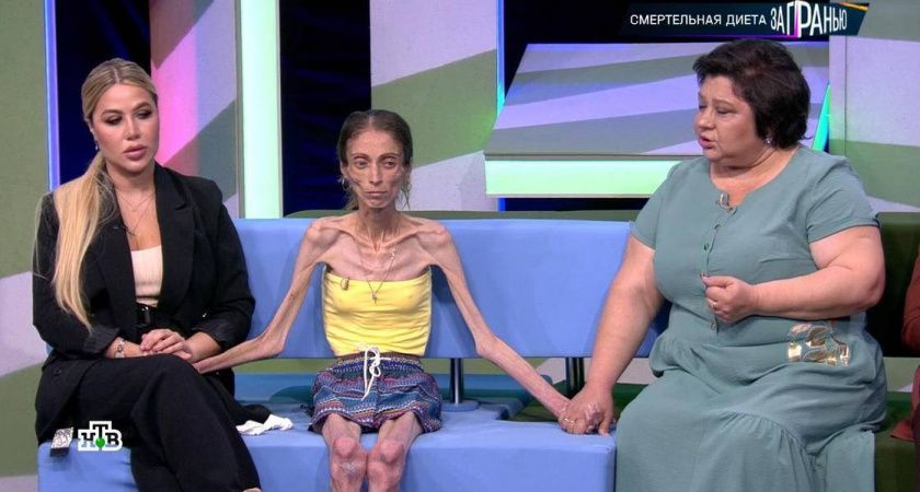 ШОК! Самую худую девушку в мире привезли в Нижний Новгород