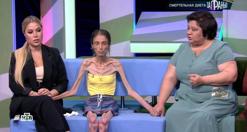 Фото к статье: Нижегородские медики спасают самую худую девушку в мире
