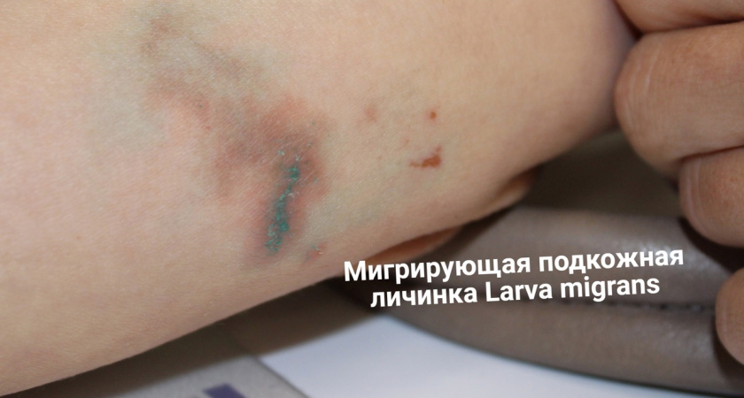 Нижегородка привезла на родину из Доминиканы опасную подкожную личинку 