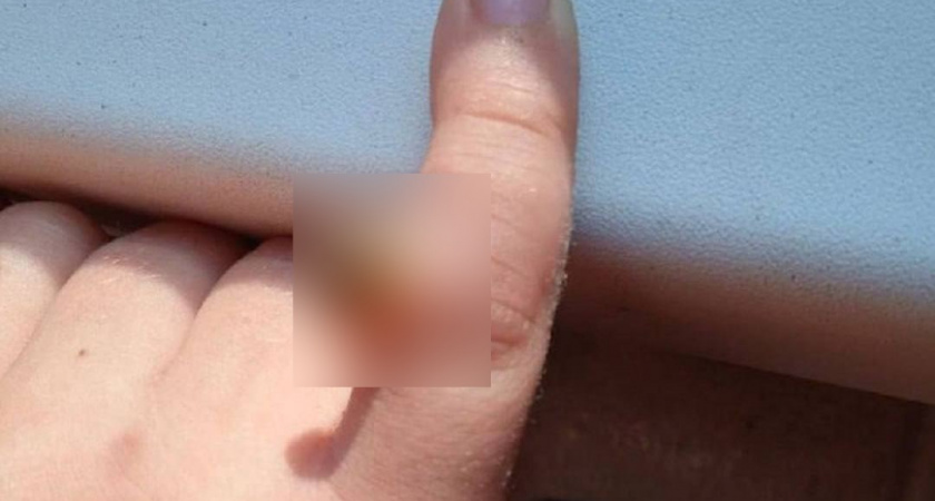 Нижегородские врачи спасли палец маленького француза от аномальной бородавки
