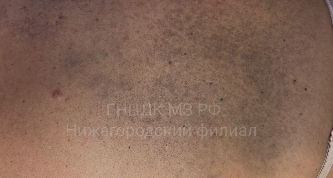 Нижегородка заболела редким вирусом, от которого еще не придумали лечение