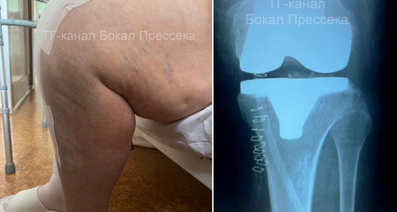 Врачи смогли поставить нижегородку на ноги, хотя операцию проводить было нельзя