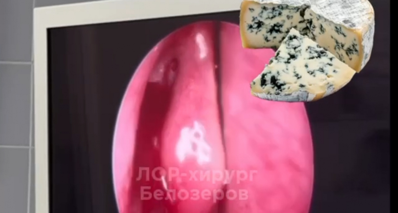 Сыровар из Нижнего Новгорода "вдохнул опасность": грибок в носу стал поводом для операции