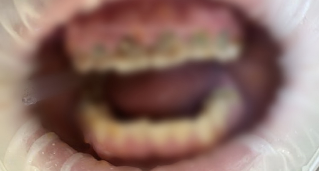 В Нижнем Новгороде парень чуть не лишился зубов из-за энергетиков