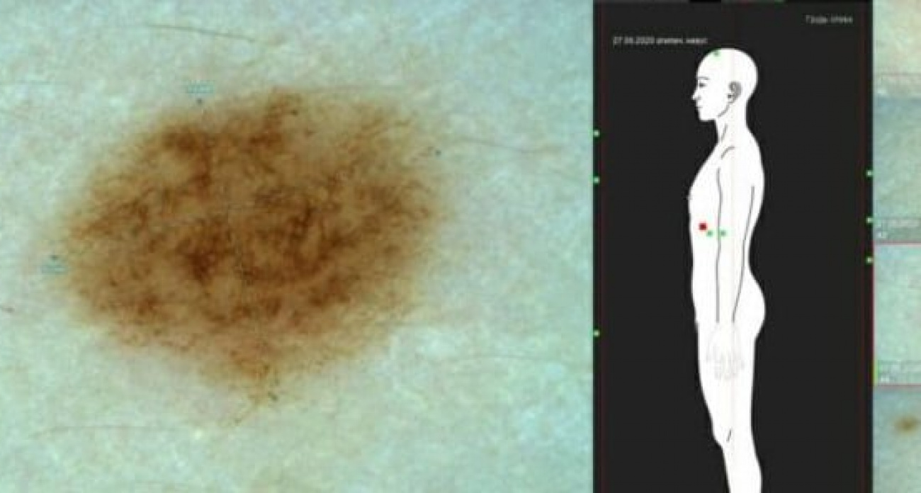 Родинка обернулась раком для 20-летней нижегородки 