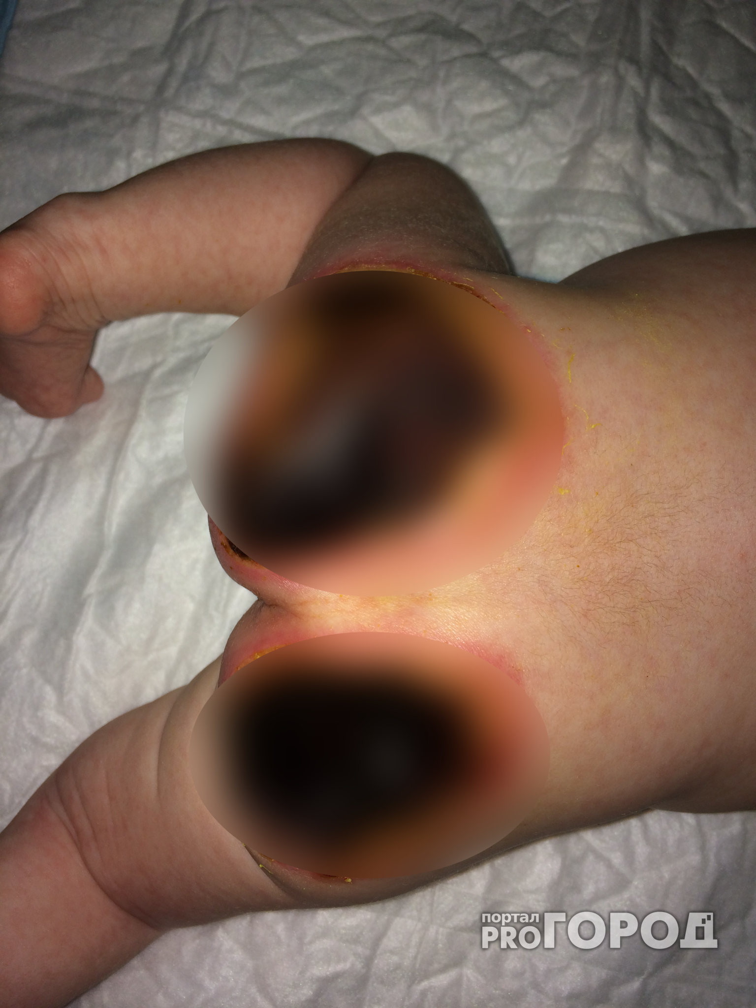 В Нижнем медсестра хотела согреть новорожденную грелкой и сожгла ее тело (ФОТО)