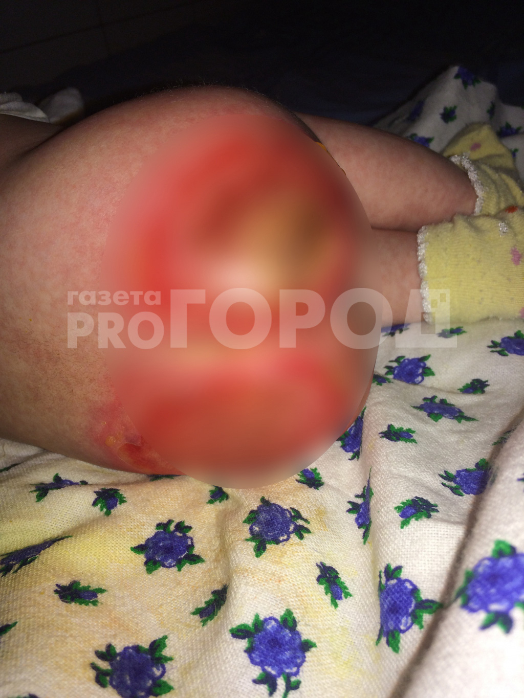 Нижегородский Минздрав наказал главврача больницы, в которой обожгли младенца