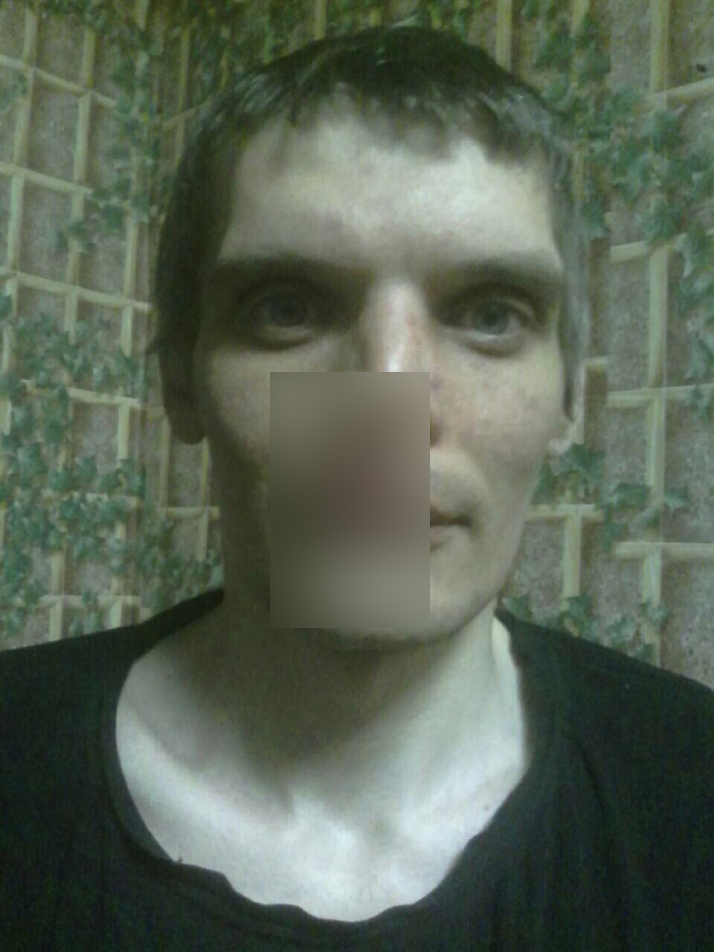 Нижегородец, которому сосед отрезал нос, побывал на шоу «Мужское и женское»
