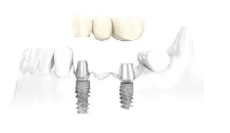 Металлокерамика в протезировании зубов
