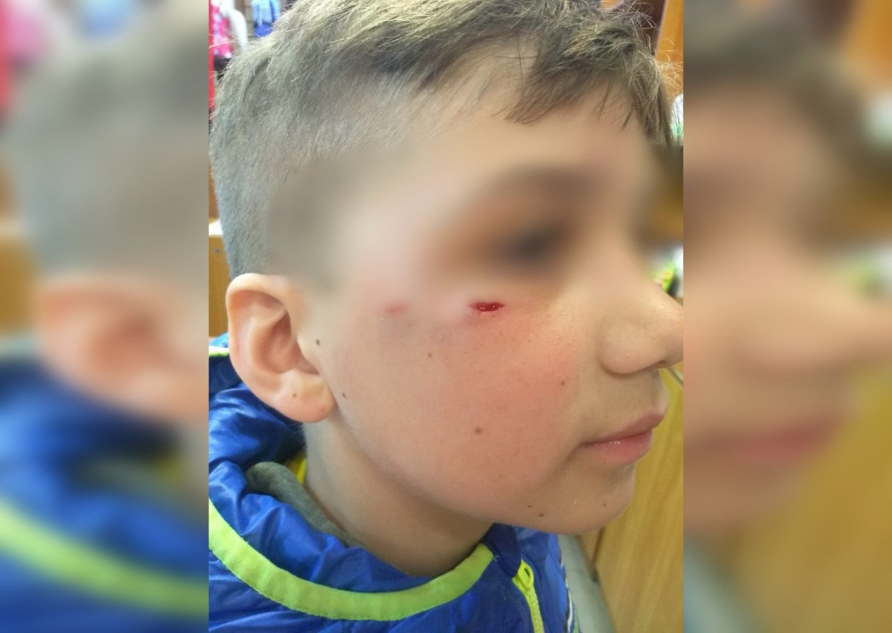 Бездомная собака искусала ребенка за лицо в Нижегородской области