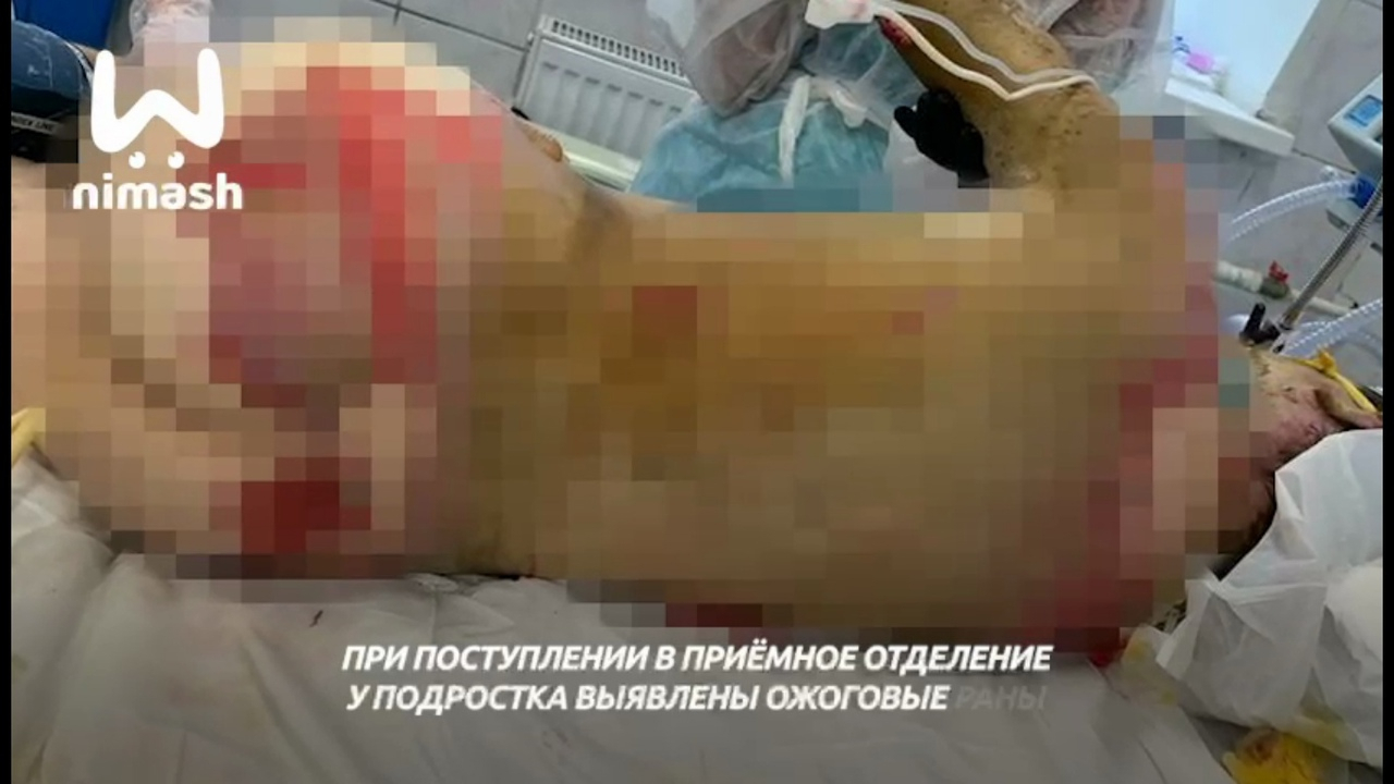 Подросток получил больше половины ожогов тела из-за удара током в Нижнем Новгороде