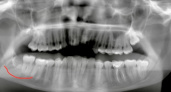 Хирурги пересадили нижегородцу его же собственный зуб вместо импланта 