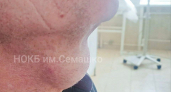Нижегородские медики удалили из горла пациента опухоль размером с яйцо