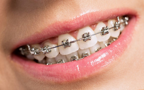 Как установить брекеты