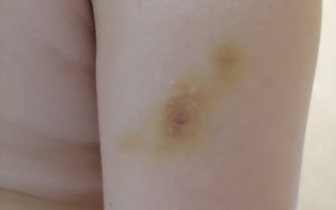 12-летний мальчик вернулся из нижегородского лечебного санатория с побоями