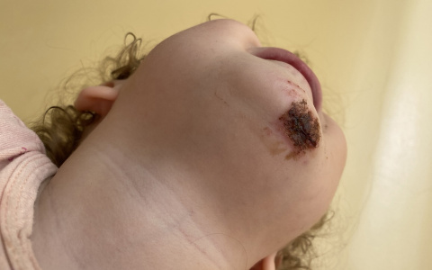 Годовалый ребенок разбил лицо, гуляя на детской площадке в Нижнем Новгороде