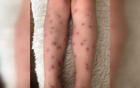 Подкожные черви-паразиты атаковали купающихся в озере Автозаводского района