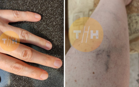 Ребенок на самокате сломал палец известному нижегородскому детскому хирургу-онкологу