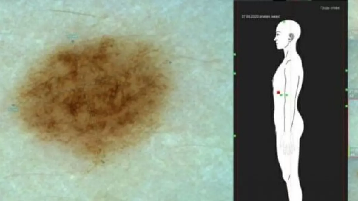 Родинка обернулась раком для 20-летней нижегородки 