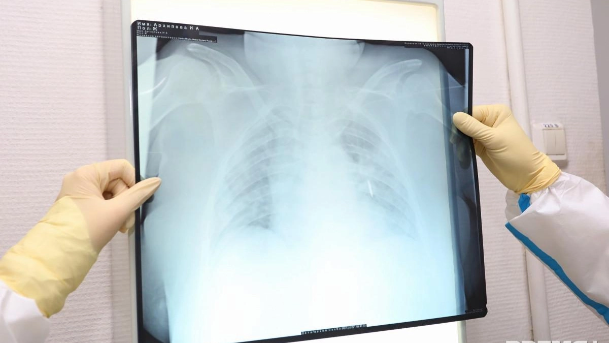 Туберкулез передается на 15 метров: врач объяснила, как защититься