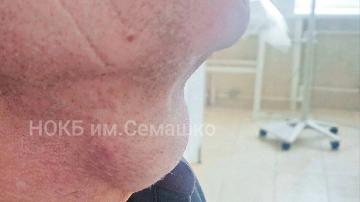 Нижегородские медики удалили из горла пациента опухоль размером с яйцо