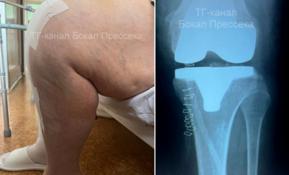 Врачи смогли поставить нижегородку на ноги, хотя операцию проводить было нельзя