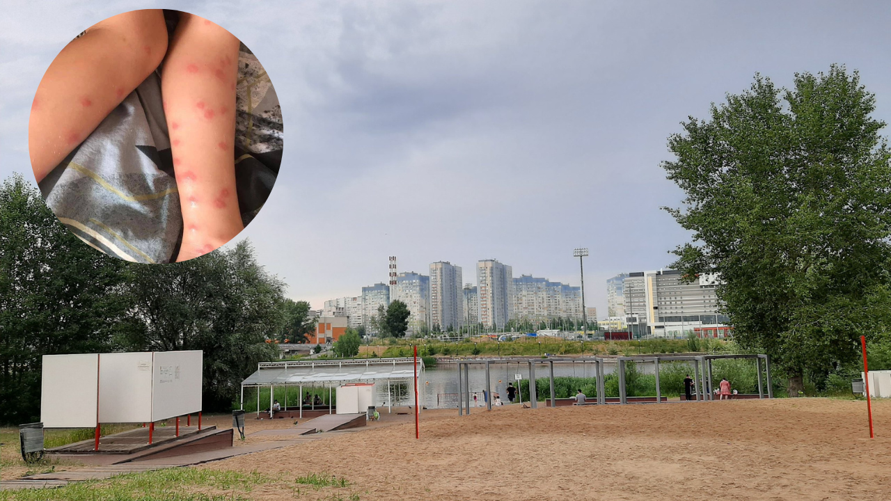 Красная сыпь и нестерпимый зуд: опасные паразиты снова терроризируют нижегородцев после купания